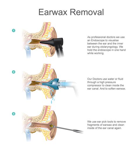 Tinnitus still remains after wax removal. . How long does dizziness last after ear wax removal